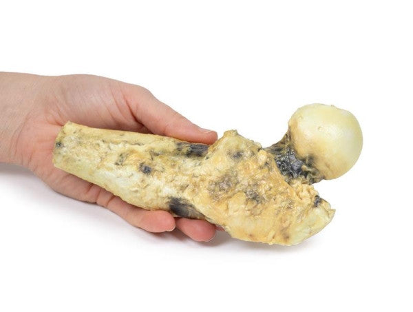 Osteosarcoma of Femur 3D Printed Anatomy Model