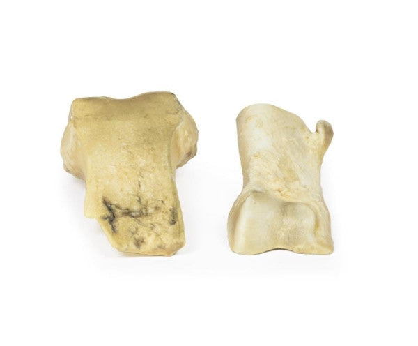 Osteochondroma 3D Printed Anatomy Model