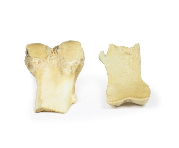 Osteochondroma 3D Printed Anatomy Model