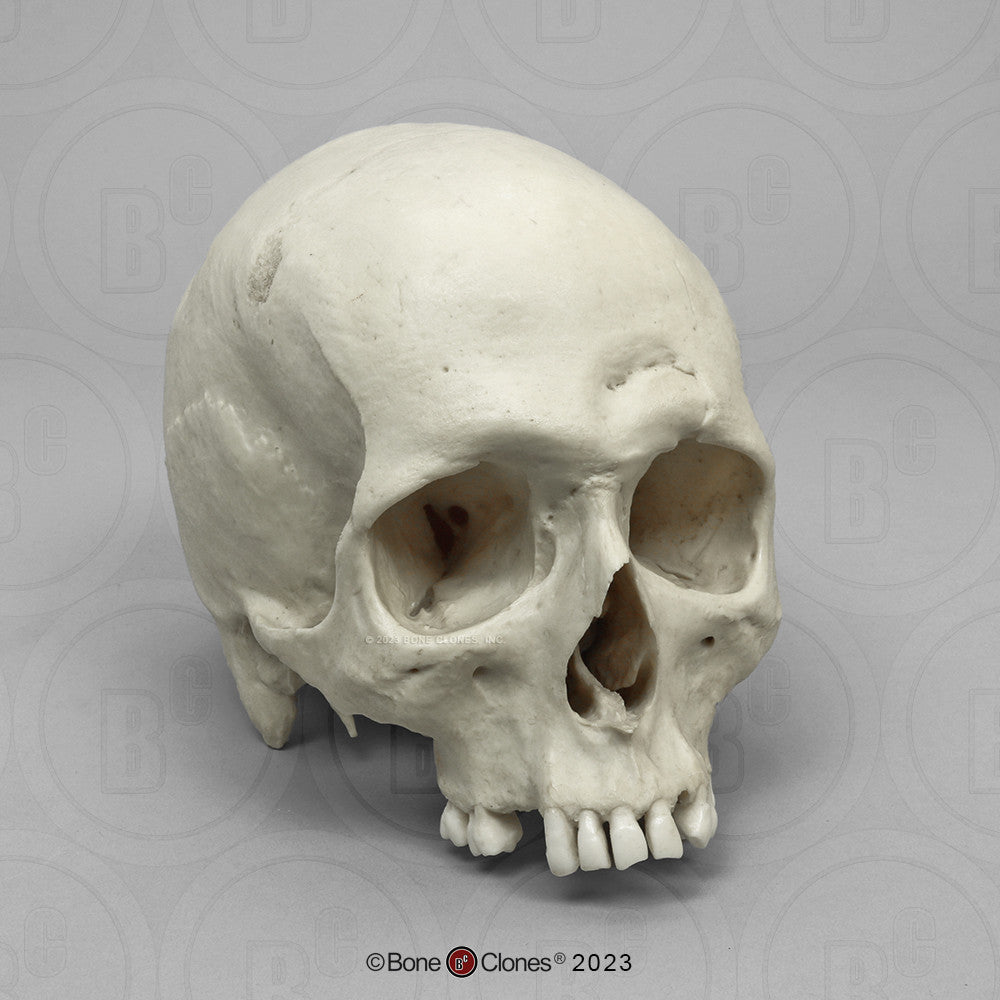 Bone Clones Forensic Trauma Skulls