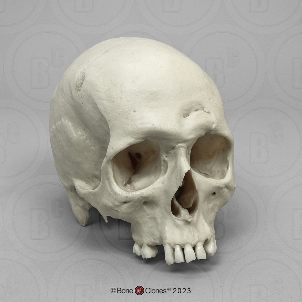 Bone Clones Forensic Trauma Skulls