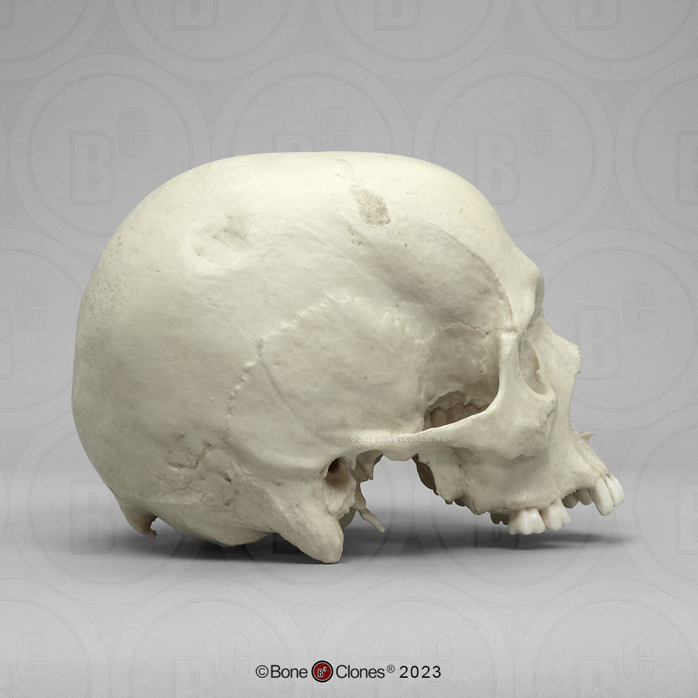 Bone Clones Forensic Trauma Skulls