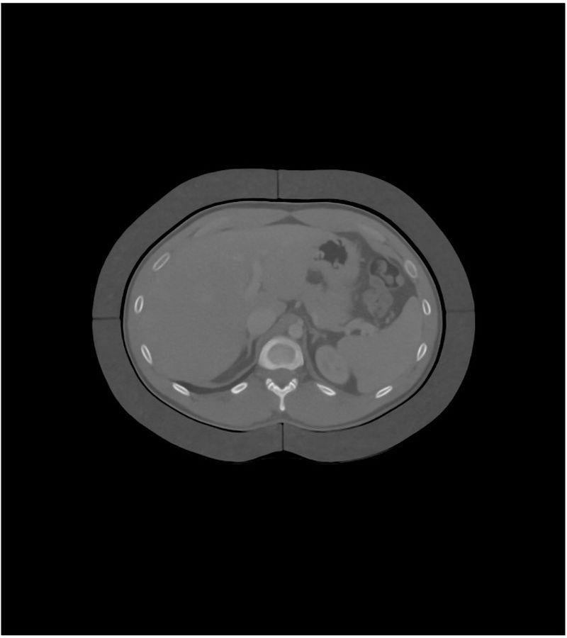 Fat Rings for Abdomen Phantom