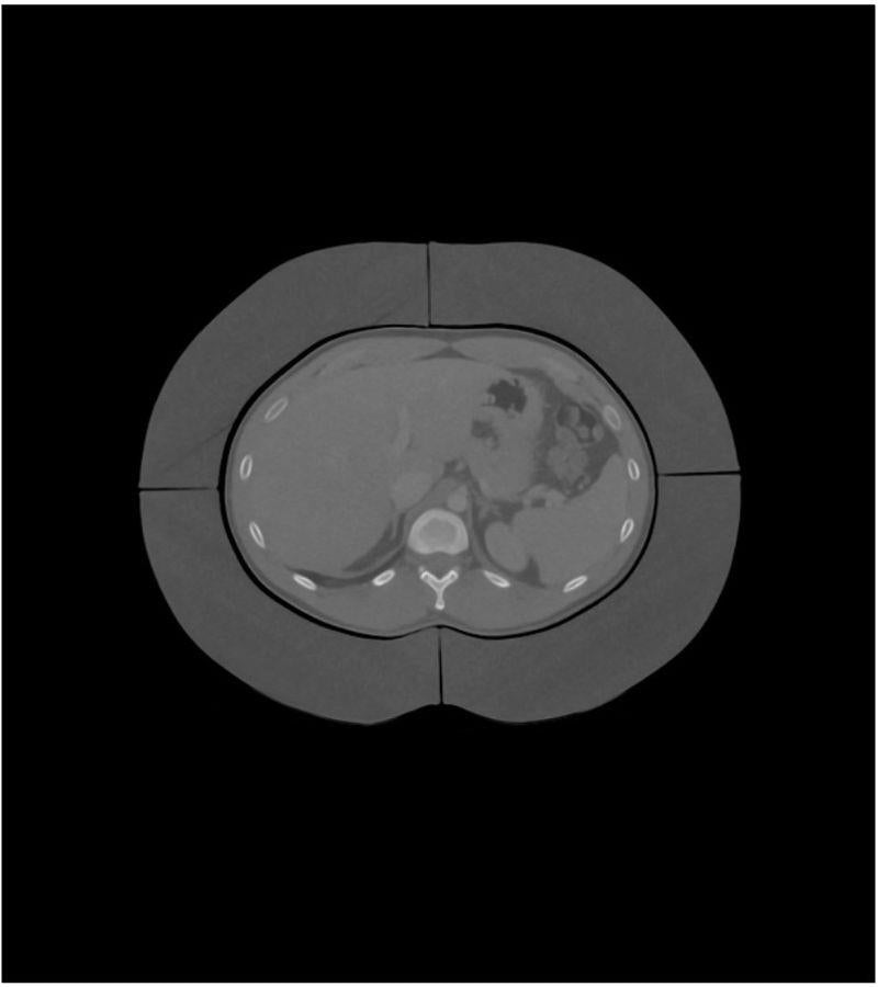 Fat Rings for Abdomen Phantom