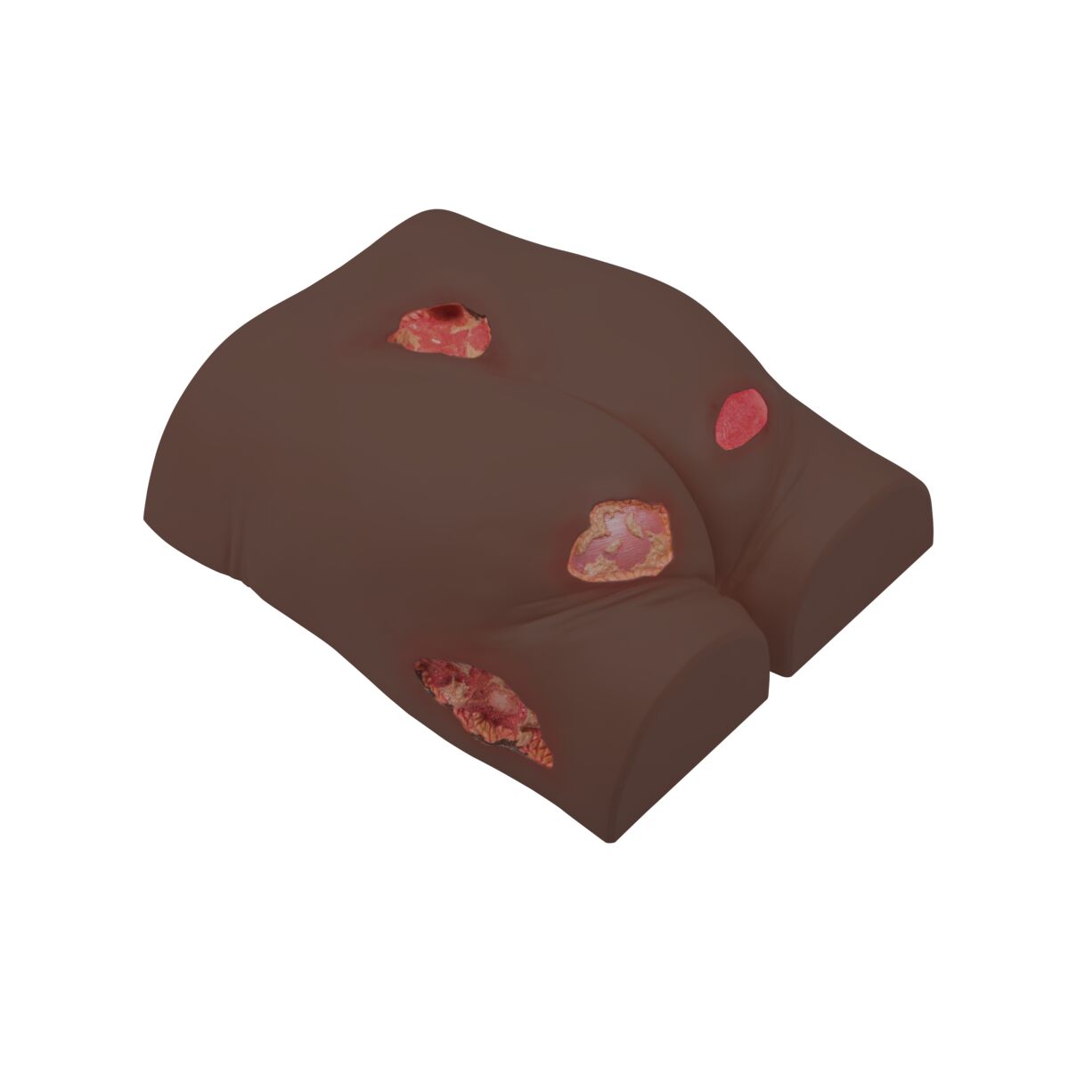 1023319 Pressure Ulcer Dark