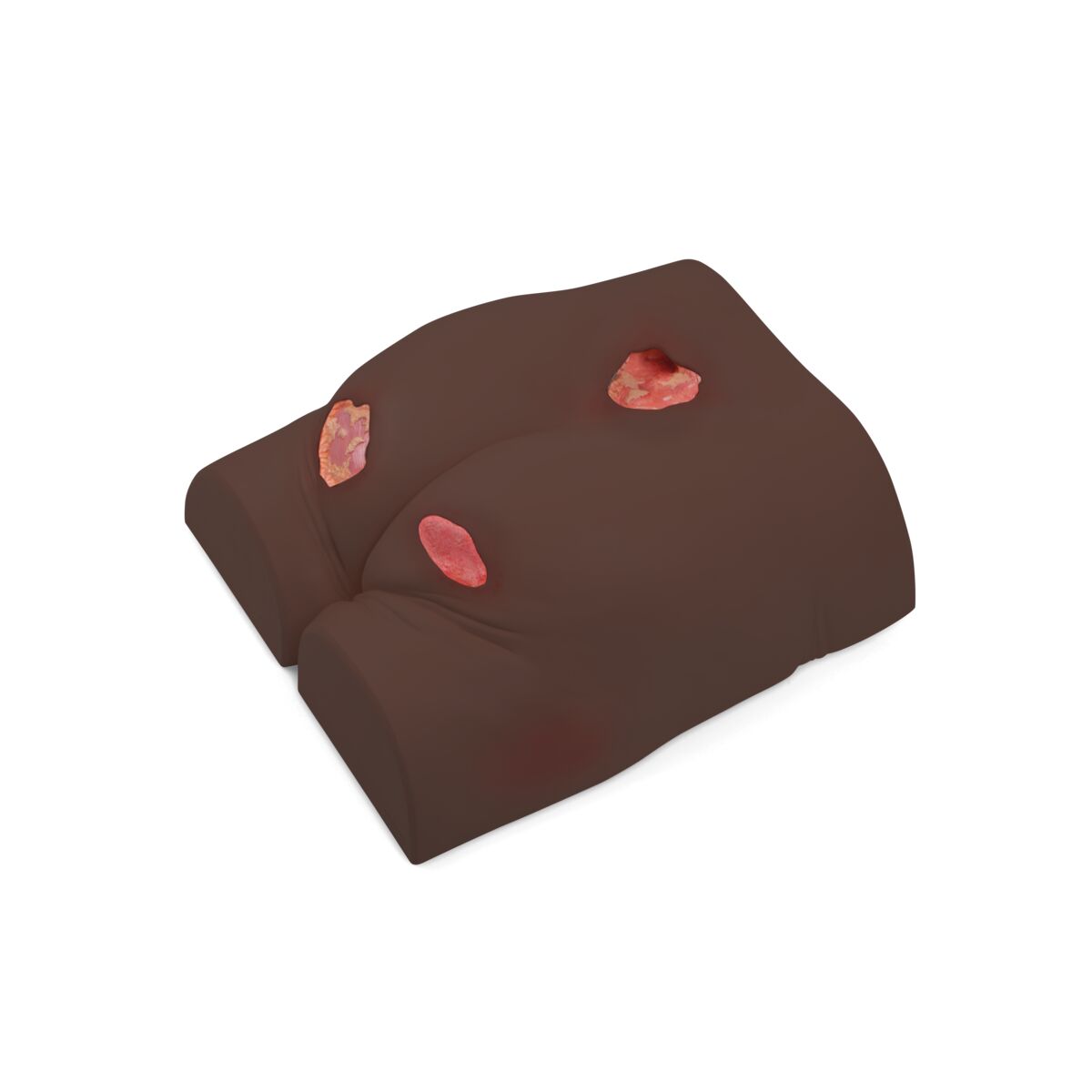 1023319 Pressure Ulcer Dark