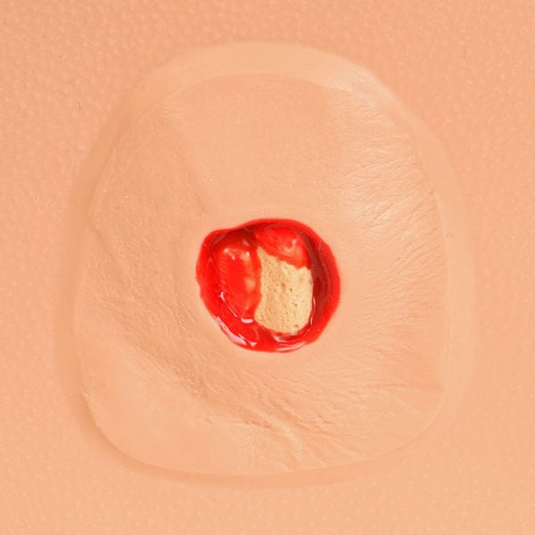 Pat Pressure Injury Staging Model