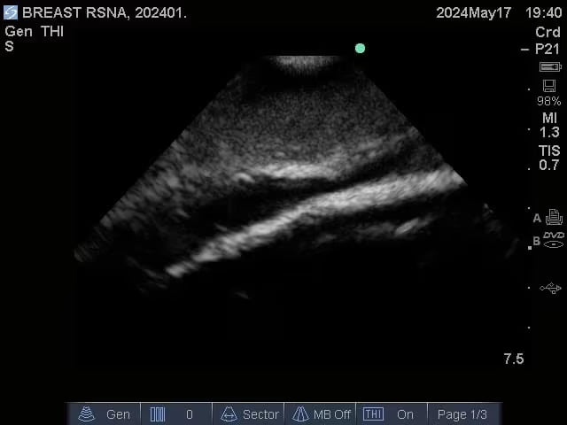 Adult Breast Phantom (Complex) for X-Ray CT, US, MRI