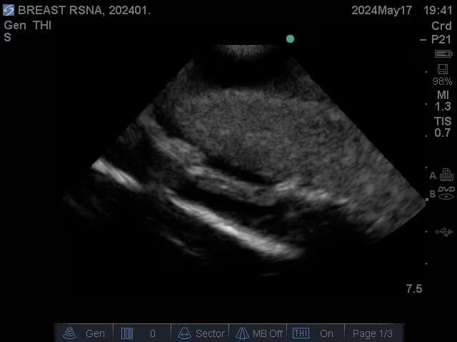 Adult Breast Phantom (Complex) for X-Ray CT, US, MRI