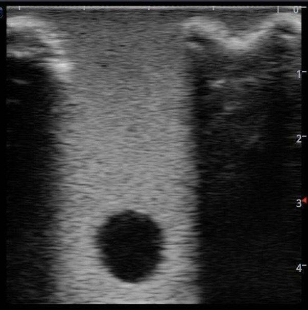 Peripherally Inserted Central Catheter (PICC) Ultrasound Training Model