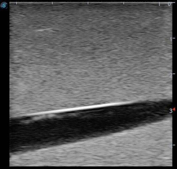 Peripherally Inserted Central Catheter (PICC) Ultrasound Training Model