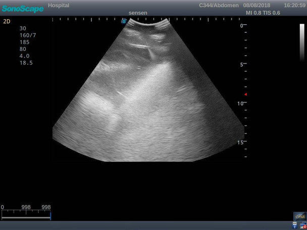 Thoracentesis Ultrasound Training Model