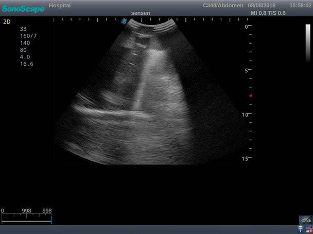 Pneumothorax and Thoracic Closed Drainage Ultrasound Training Model
