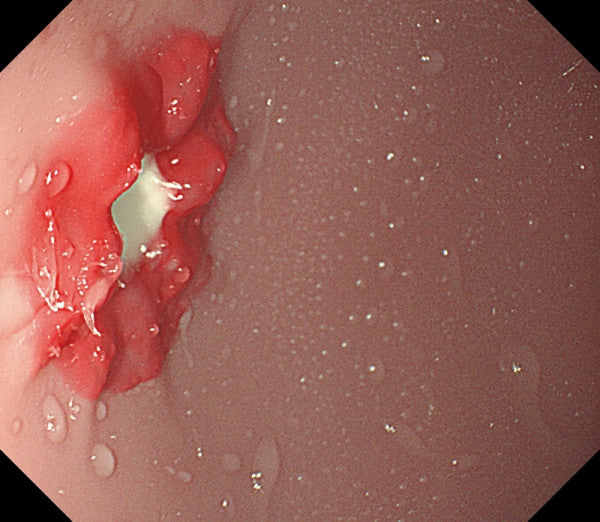 Replicated Ulcers and Polyps for Observation