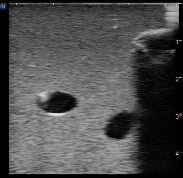 Peripherally Inserted Central Catheter (PICC) Ultrasound Training Model