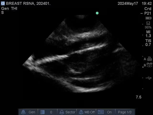 Adult Breast Phantom (Complex) for X-Ray CT, US, MRI