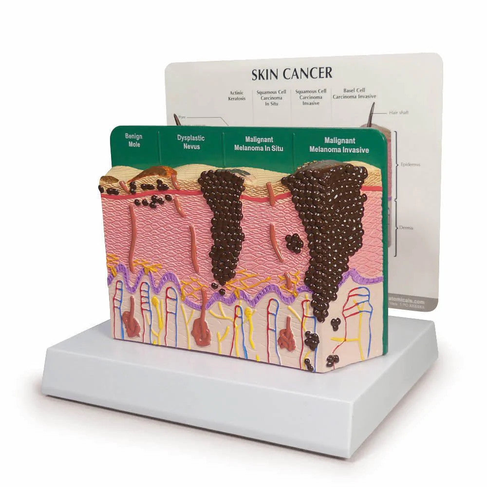 Skin Cancer Model with Charts
