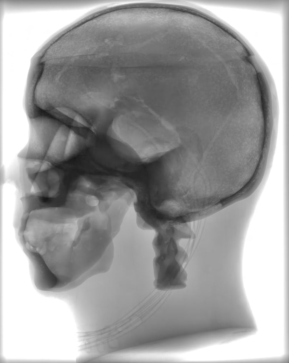 Adult Head Phantom (Standard) for X-Ray CT, US, MRI