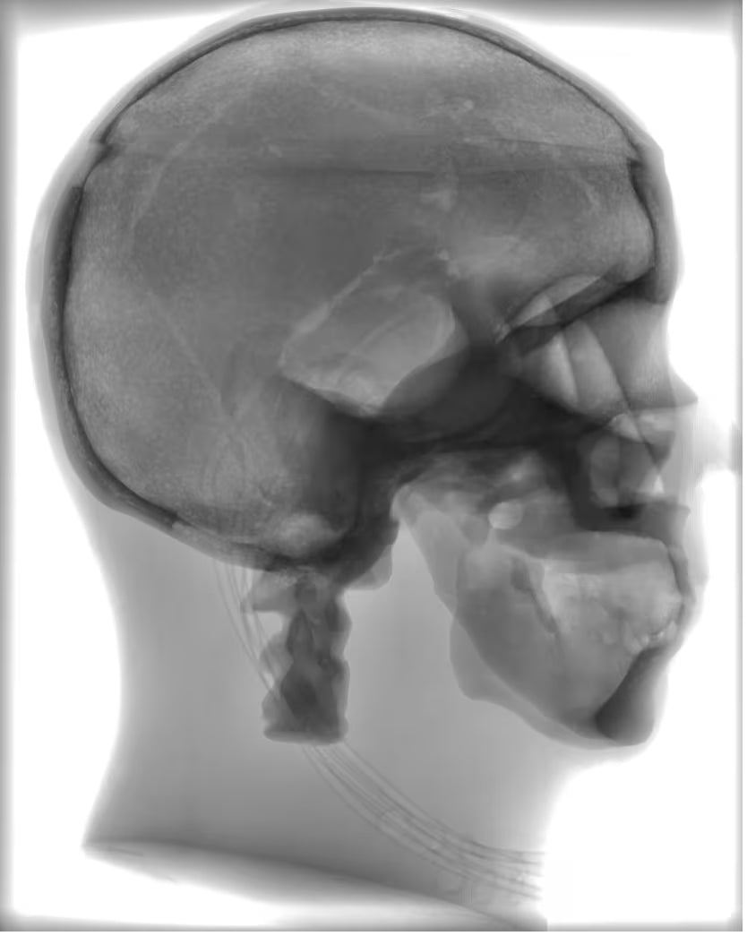 Adult Head Phantom (Standard) for X-Ray CT, US, MRI