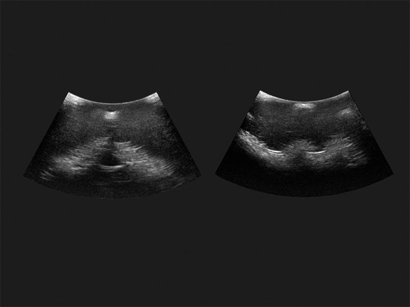 Epidural-Spinal Injection Simulator GENESIS