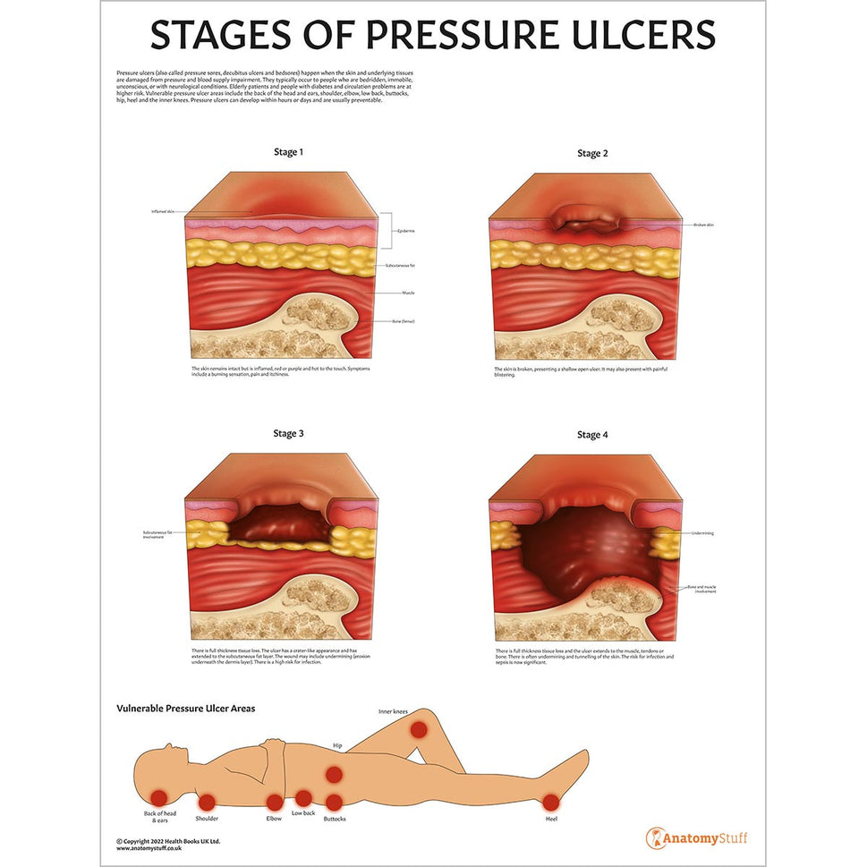 Pressure Ulcers Collection