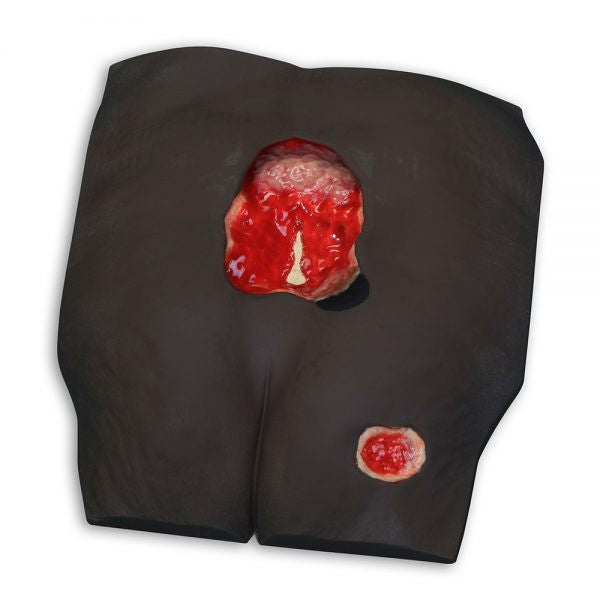 Stan Stage 4 Sacral Pressure Injury Model