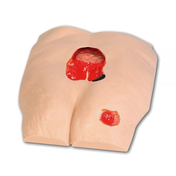 Stan Stage 4 Sacral Pressure Injury Model