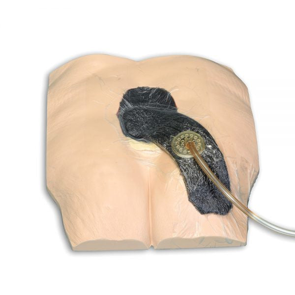 Stan Stage 4 Sacral Pressure Injury Model