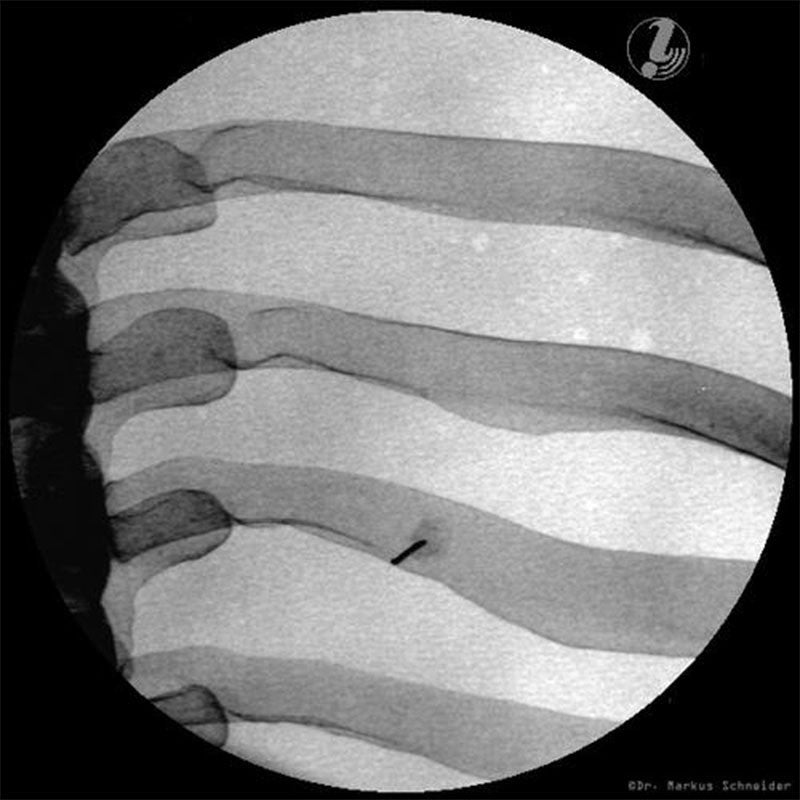 Thoracic Spine Injection Trainer