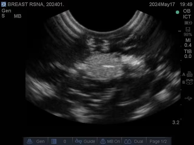 Adult Breast Phantom (Complex) for X-Ray CT, US, MRI