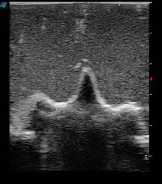 Paediatric Lumbar Puncture Ultrasound Training Model