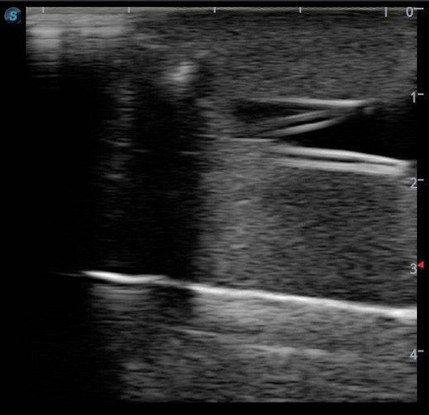 Peripherally Inserted Central Catheter (PICC) Ultrasound Training Model