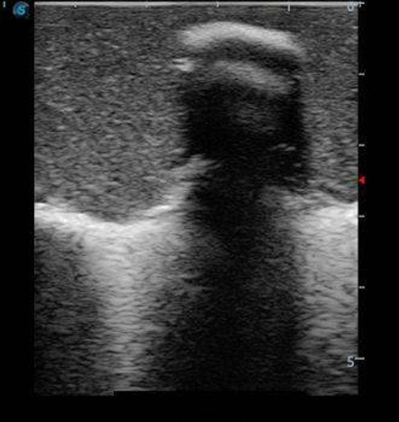 Paediatric Lumbar Puncture Ultrasound Training Model