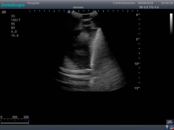 Pneumothorax and Thoracic Closed Drainage Ultrasound Training Model