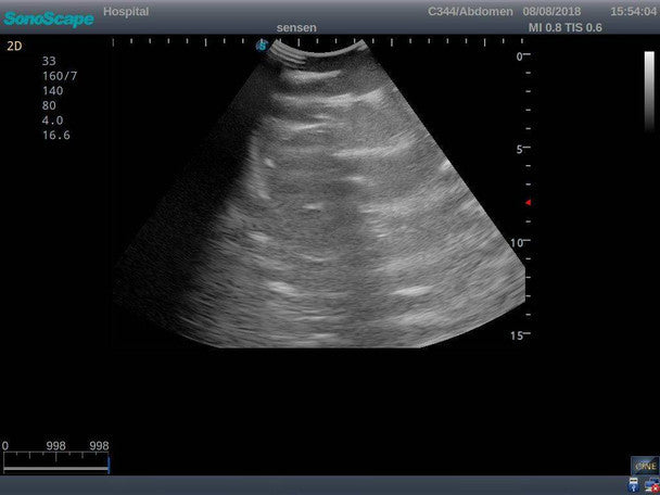 Pneumothorax and Thoracic Closed Drainage Ultrasound Training Model