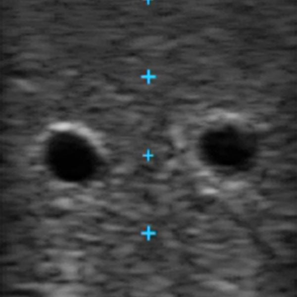 Vascular Access Ultrasound Phantom (3 Vein Bifurcated)