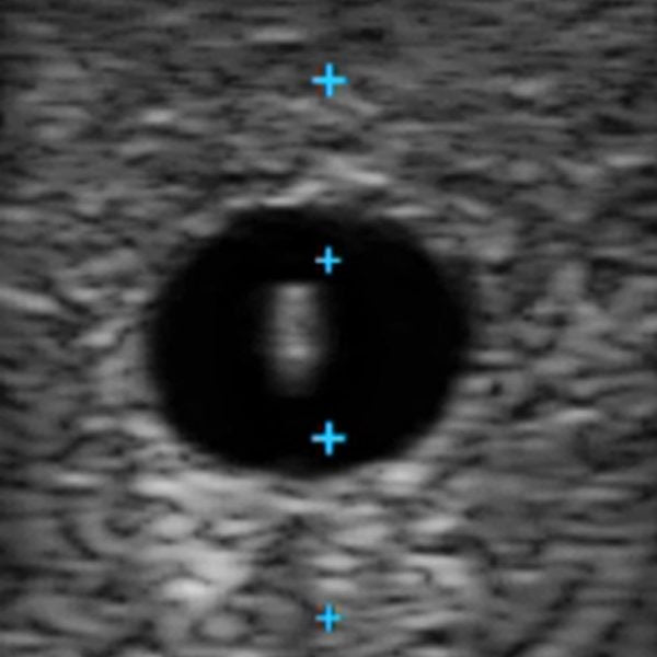 Vascular Access Ultrasound Phantom (3 Vein Bifurcated)
