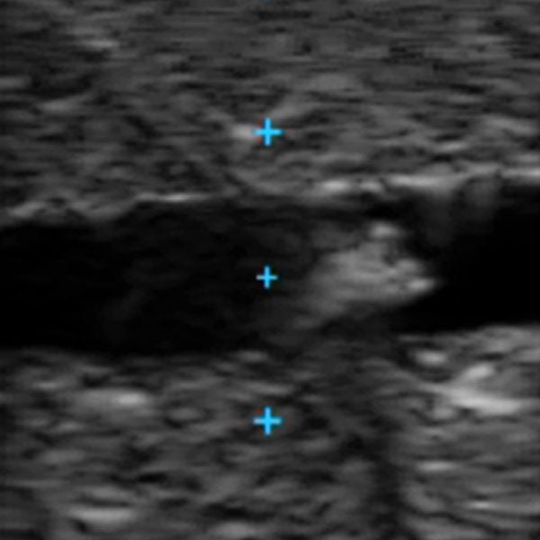 Vascular Access Ultrasound Phantom (3 Vein Bifurcated)