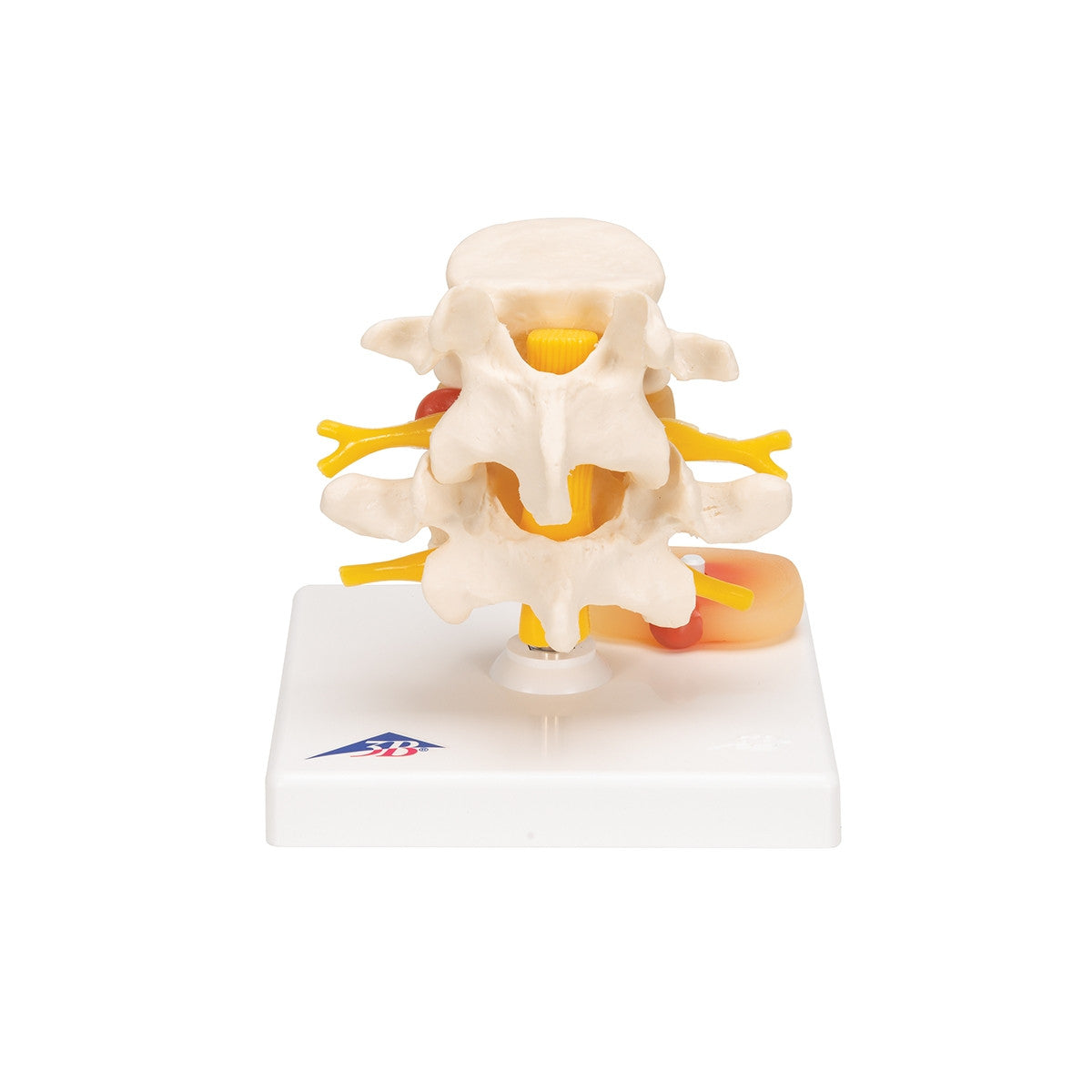 Lumbar Spine Model with Prolapsed Intervertebral Disc 1000149