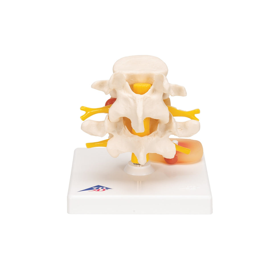Lumbar Spine Model with Prolapsed Intervertebral Disc