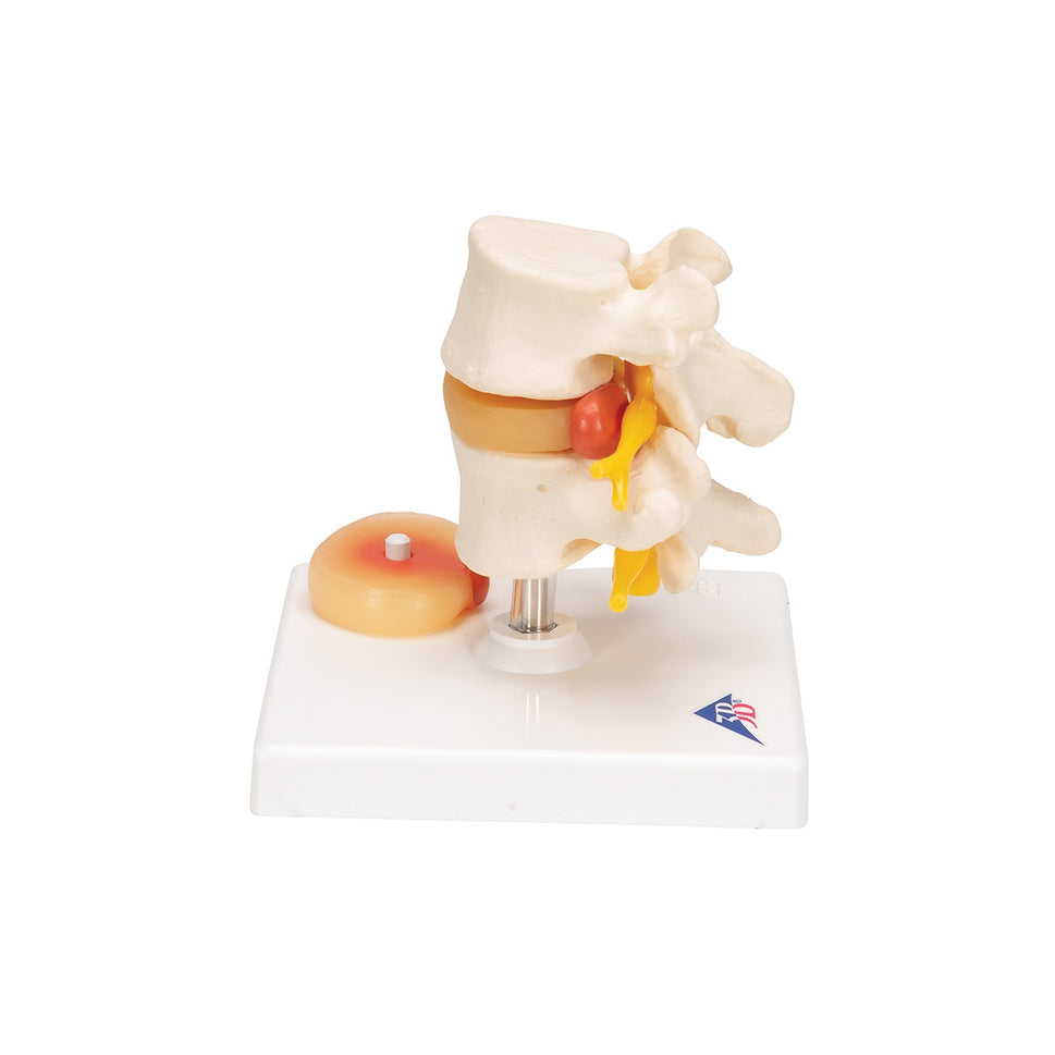 Lumbar Spine Model with Prolapsed Intervertebral Disc