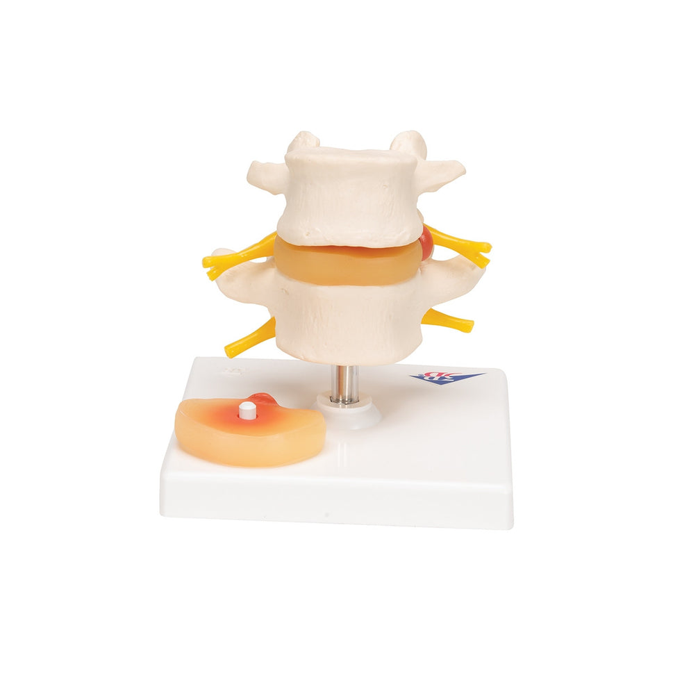 Lumbar Spine Model with Prolapsed Intervertebral Disc