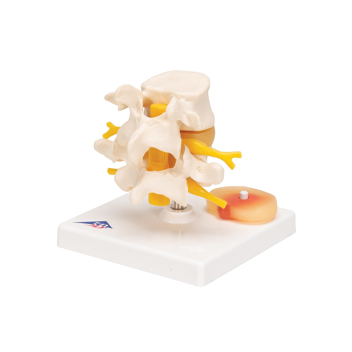 Lumbar Spine Model with Prolapsed Intervertebral Disc