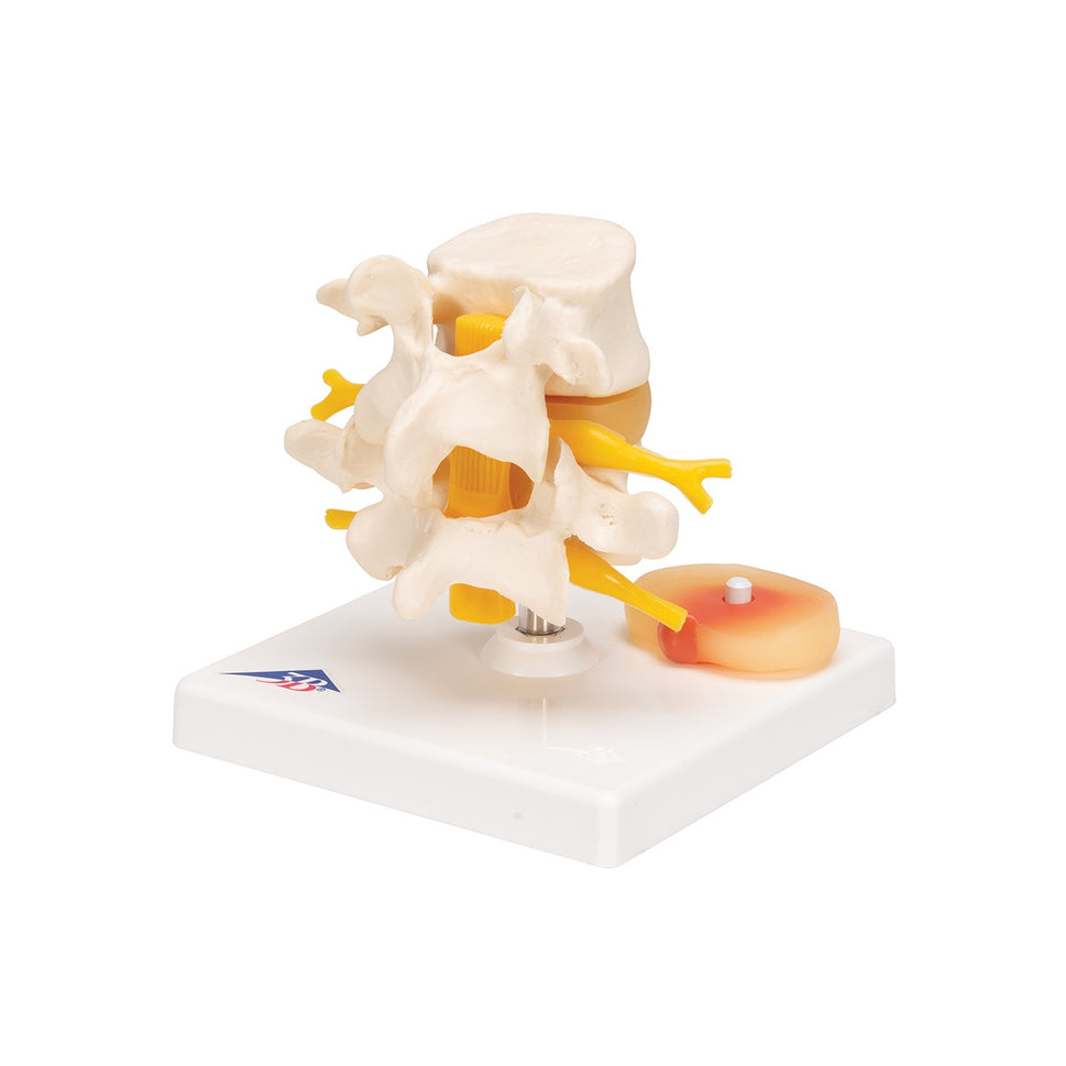 Lumbar Spine Model with Prolapsed Intervertebral Disc