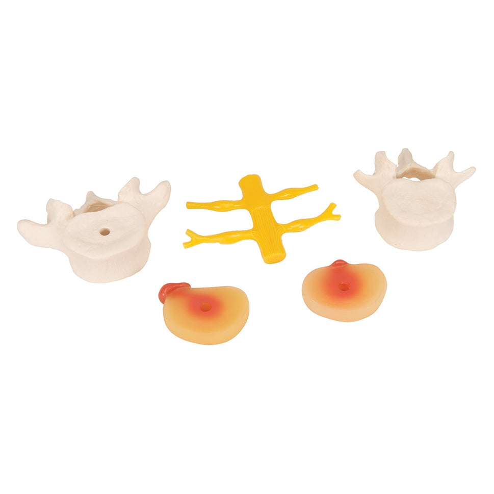 Lumbar Spine Model with Prolapsed Intervertebral Disc