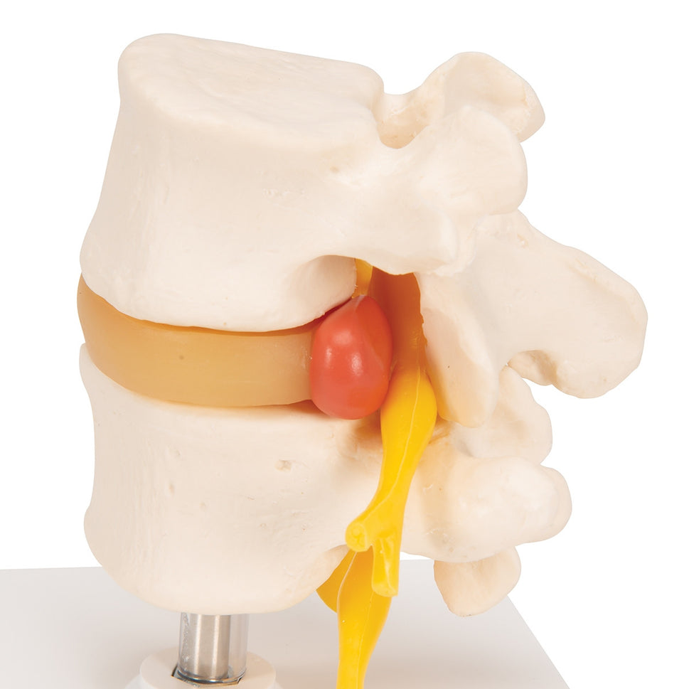 Lumbar Spine Model with Prolapsed Intervertebral Disc
