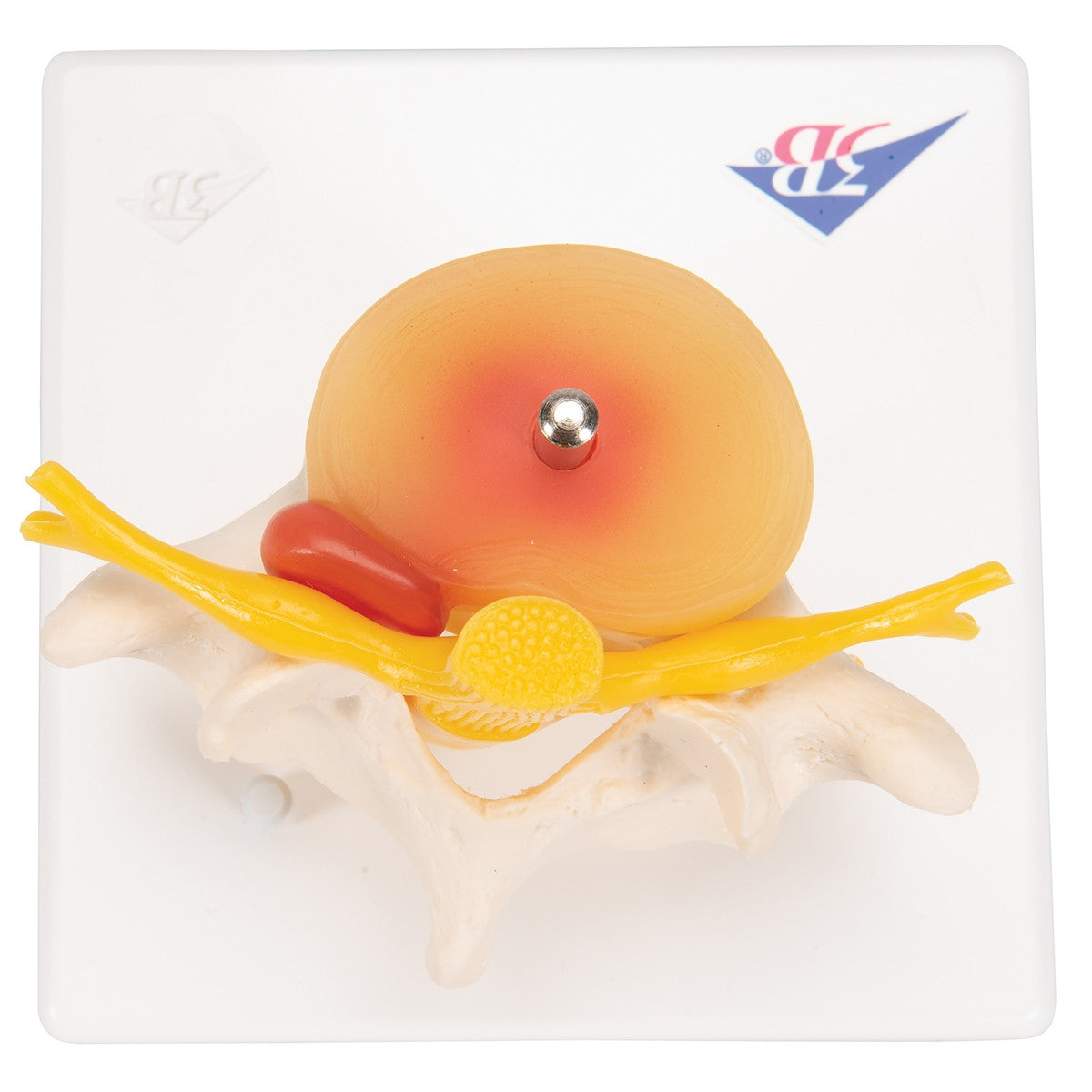 Lumbar Spine Model with Prolapsed Intervertebral Disc
