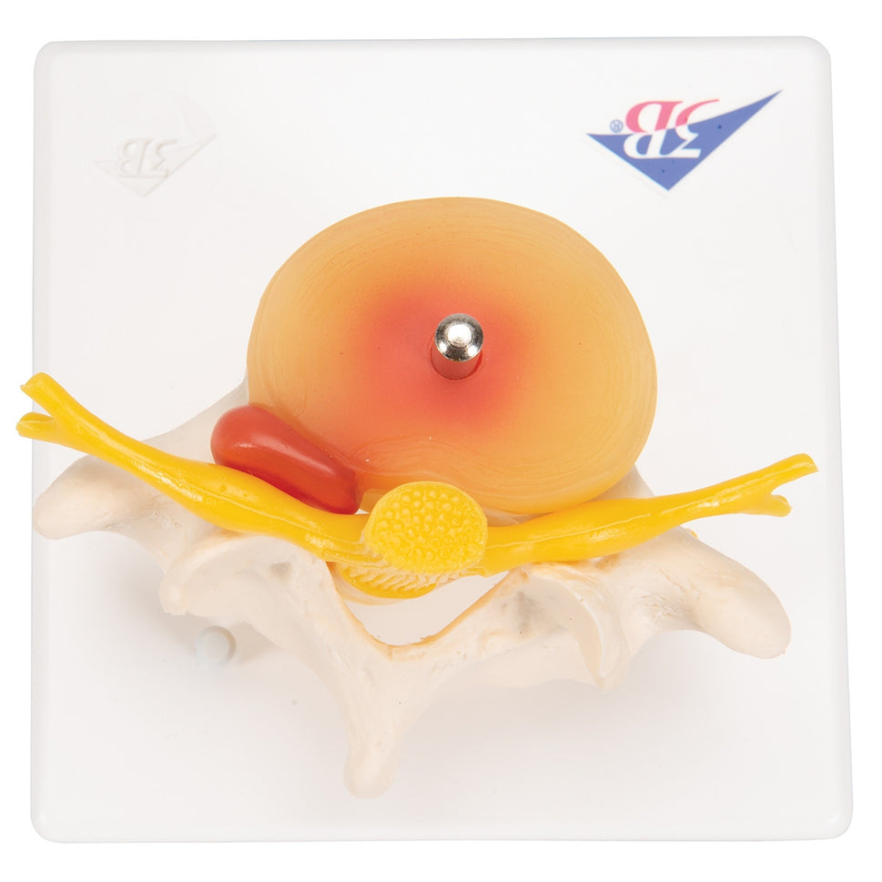 Lumbar Spine Model with Prolapsed Intervertebral Disc