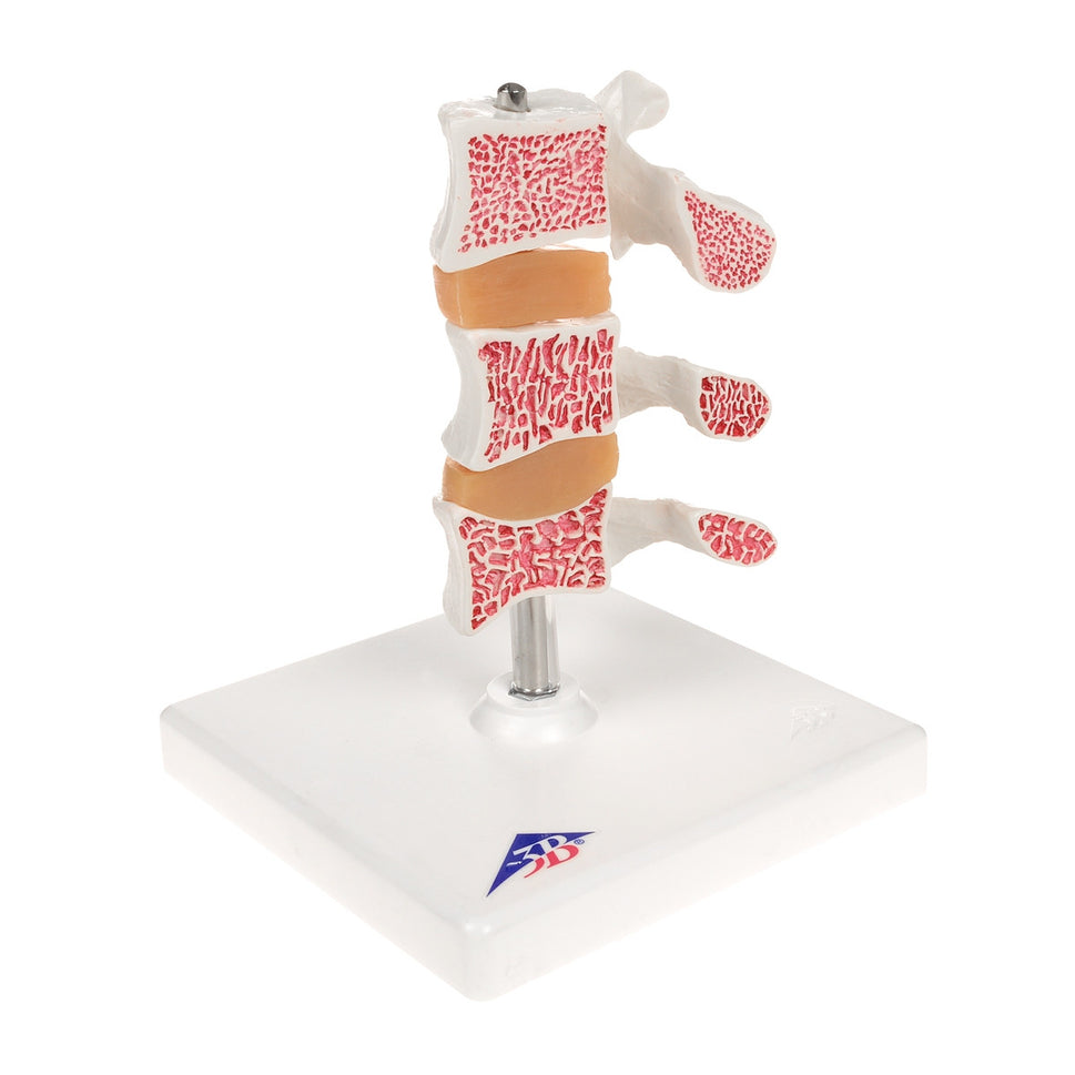 Osteoporosis Model (3 Vertebrae)