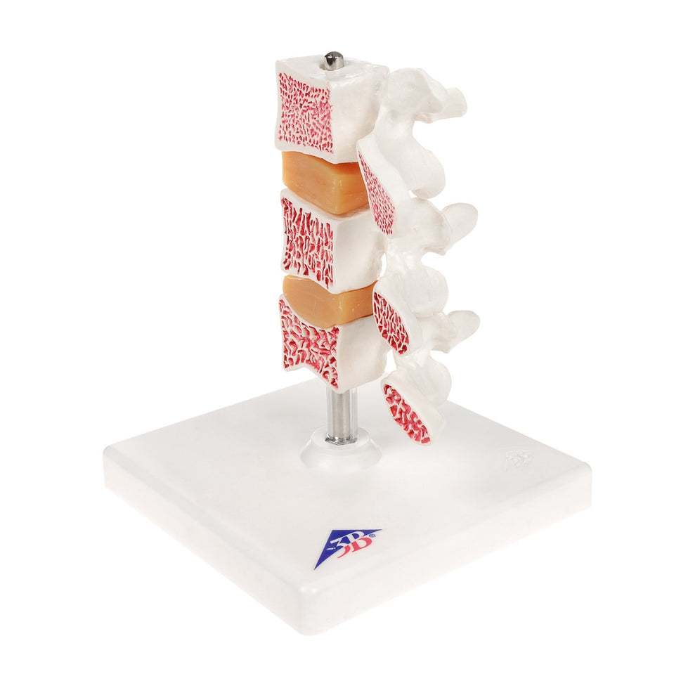 Osteoporosis Model (3 Vertebrae)